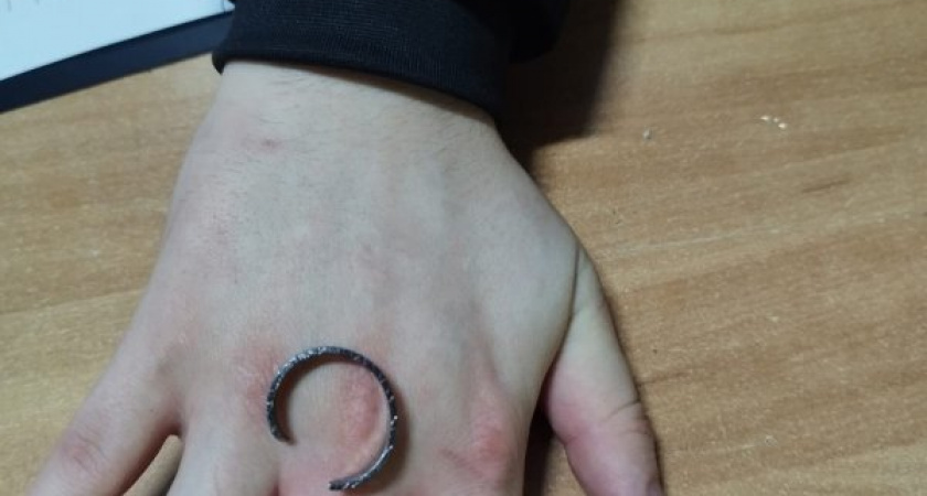Спасатели сняли застрявшее кольцо с опухшего пальца курянина